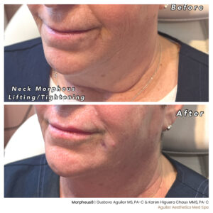 Morpheus8 Before and After Gallery | Aguilar Aesthtics med Spa