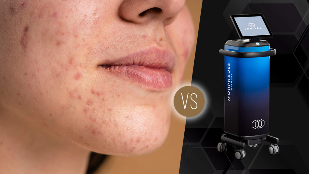 Can Morpheus8 Reduce Acne Scars?