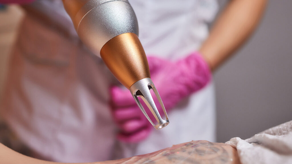Photo young woman undergoing laser tattoo removal procedure - How much does a Tattoo Removal Cost?
