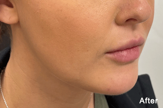 QuantumRF10 Jawline After Dr. Maningas 2 » Aguilar Aesthetics Medspa & Wellness