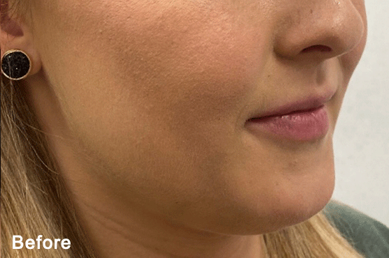 QuantumRF10 Jawline Before Dr. Maningas » Aguilar Aesthetics Medspa & Wellness