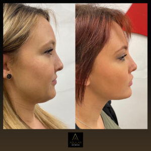 QuantumRF at Aguilar Aesthetics Medspa in Aventura, FL