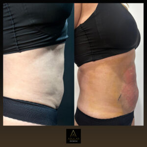 QuantumRF at Aguilar Aesthetics Medspa in Aventura, FL