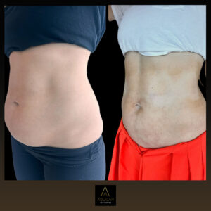 QuantumRF at Aguilar Aesthetics Medspa in Aventura, FL