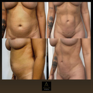 QuantumRF at Aguilar Aesthetics Medspa in Aventura, FL