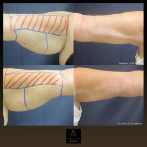 QuantumRF at Aguilar Aesthetics Medspa in Aventura, FL