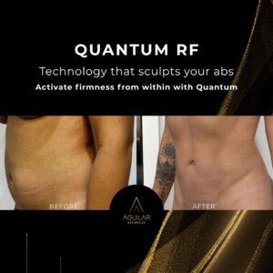quantumrf gallery 21 » Aguilar Aesthetics Medspa & Wellness
