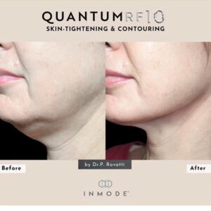 QuantumRF at Aguilar Aesthetics Medspa in Aventura, FL