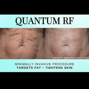 QuantumRF at Aguilar Aesthetics Medspa in Aventura, FL