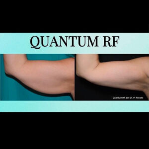 QuantumRF at Aguilar Aesthetics Medspa in Aventura, FL