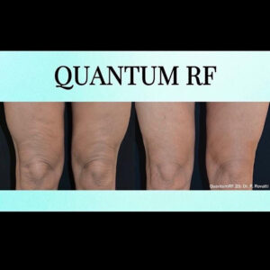 QuantumRF at Aguilar Aesthetics Medspa in Aventura, FL