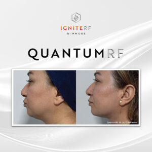 QuantumRF at Aguilar Aesthetics Medspa in Aventura, FL