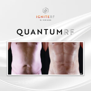 QuantumRF at Aguilar Aesthetics Medspa in Aventura, FL