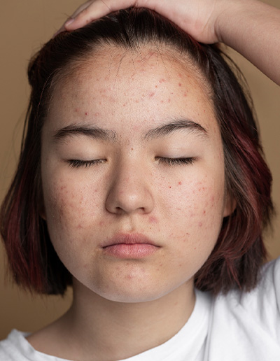 Acne & Acne Scars