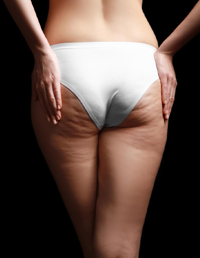 Cellulite Treatment