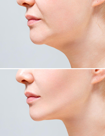 Double Chin Reduction