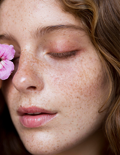 Hyperpigmentation