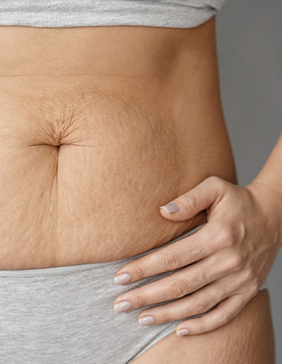 Stretch Marks