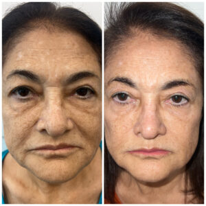 iBlaze CO2 Laser Resurfacing at Aguilar Aesthetics Medspa