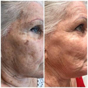 iBlaze CO2 Laser Resurfacing at Aguilar Aesthetics Medspa