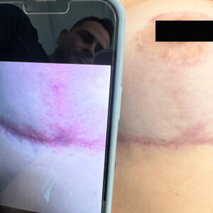 iBlaze CO2 Laser Resurfacing at Aguilar Aesthetics Medspa