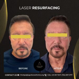 CO2 Laser Treatment in Miami by Aguilar Aesthetics Medspa